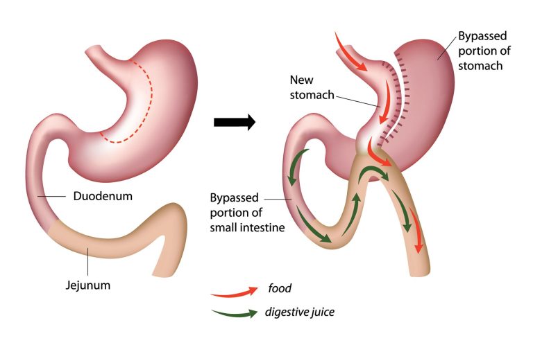 gastric bypass surgery turkey