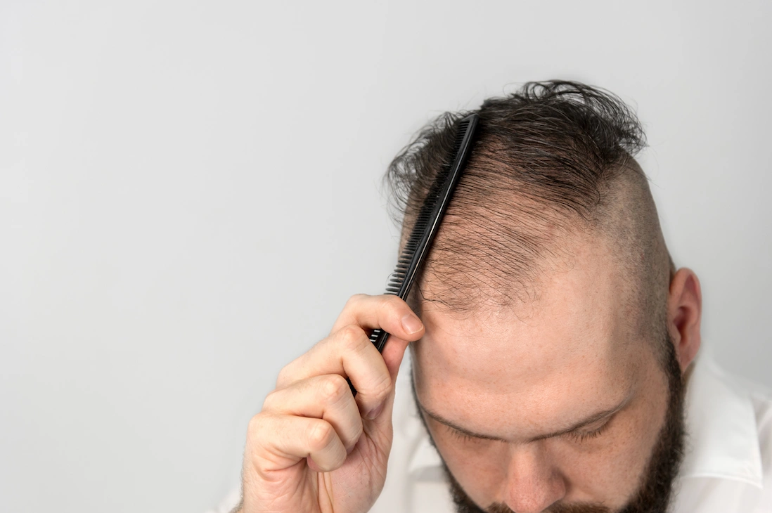 Sitosterol Hair Loss
