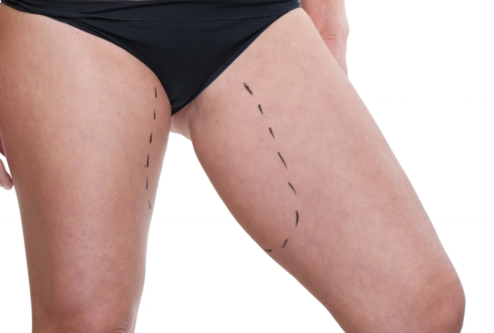 Cost of thigh lift surgery